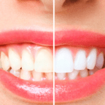 teeth discoloration due to vitamin deficiency