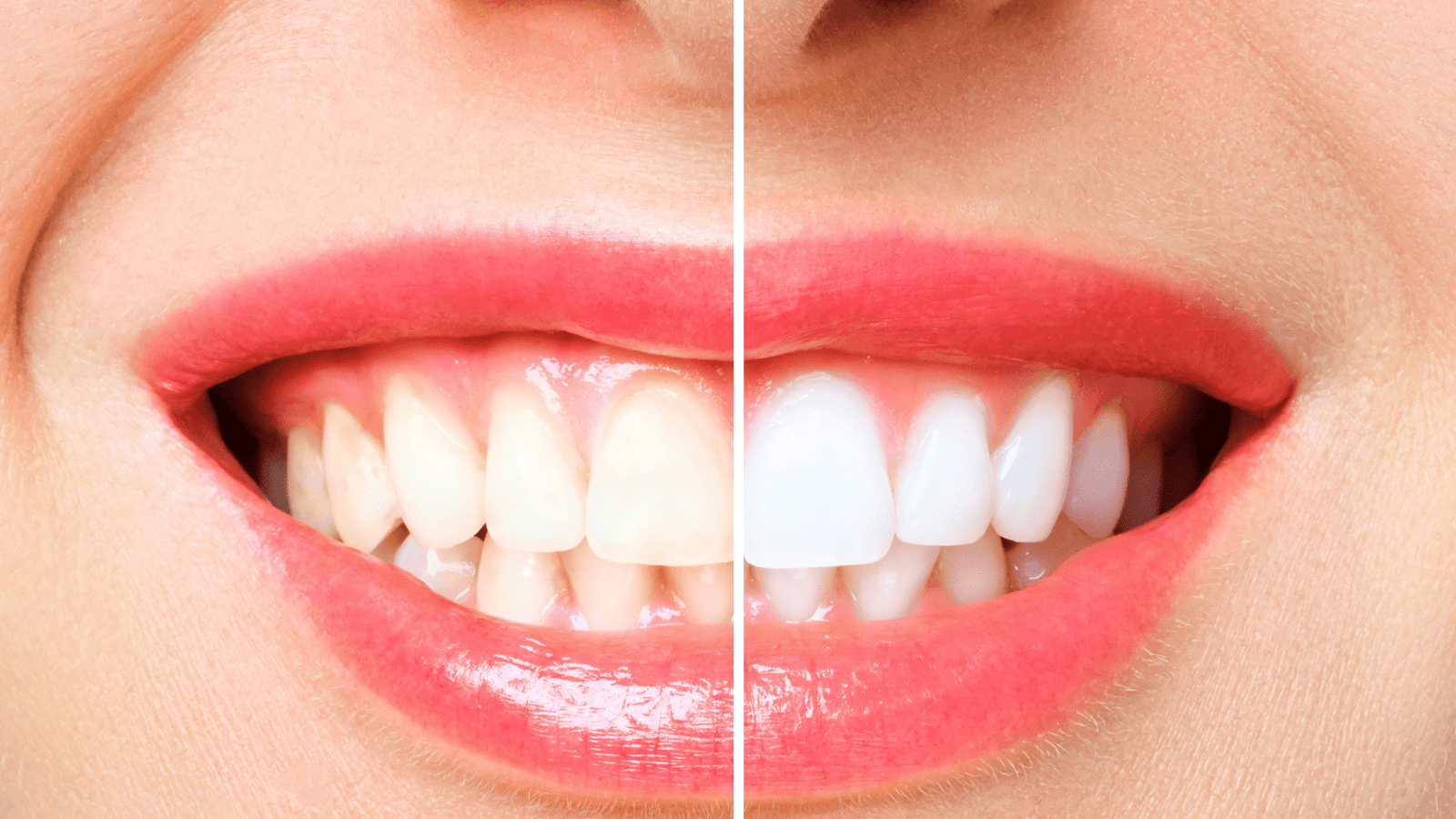 teeth discoloration due to vitamin deficiency